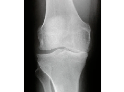 Diagnosis of osteoarthritis of the knee joint