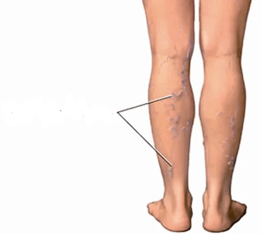 The consequences of knee osteoarthritis