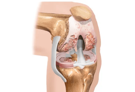 osteoarthritis or arthritis of differences