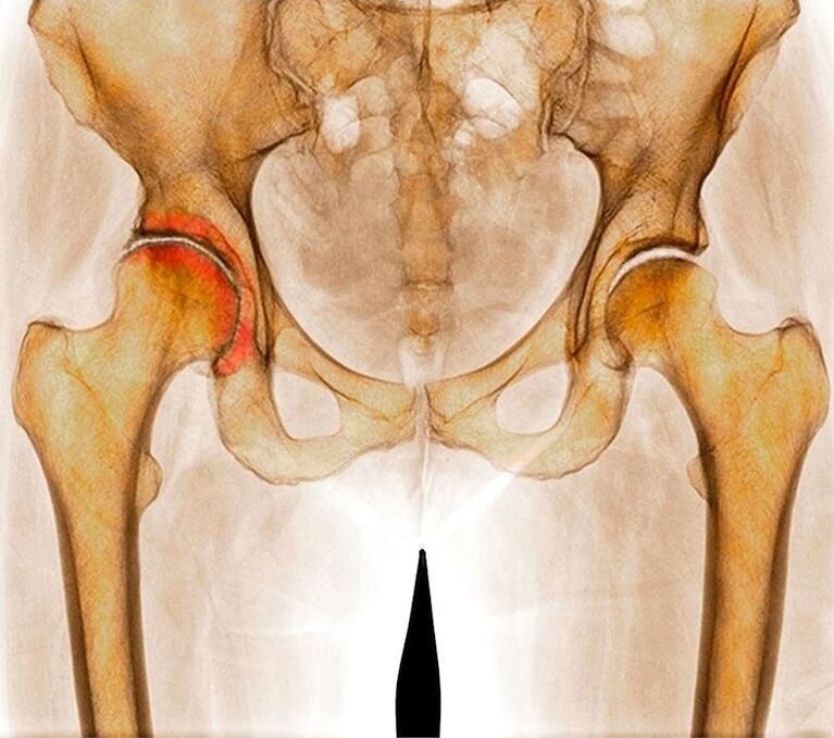 Hip joint articulation