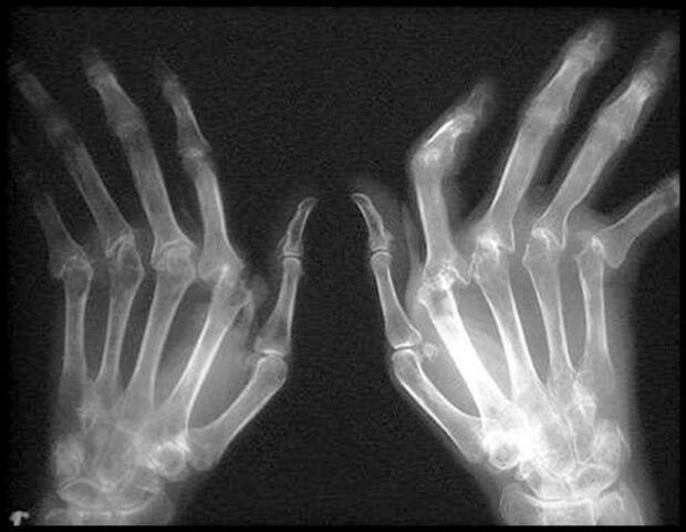Picture X-Ray of hands affected by osteoarthritis