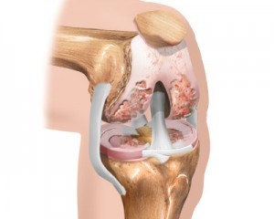 the initial stage of osteoarthritis of the knee