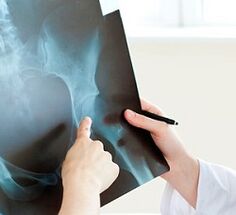 How to treat osteoarthritis on hip joint