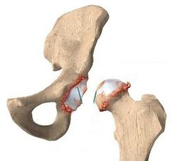 The reasons for the development of osteoarthritis of the hip joint