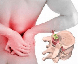 Lumbago at the start of osteochondrosis of the disease