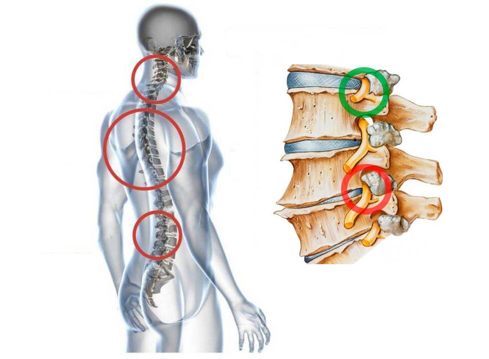 To what cervical osteochondrosis of the vertebrae looks like