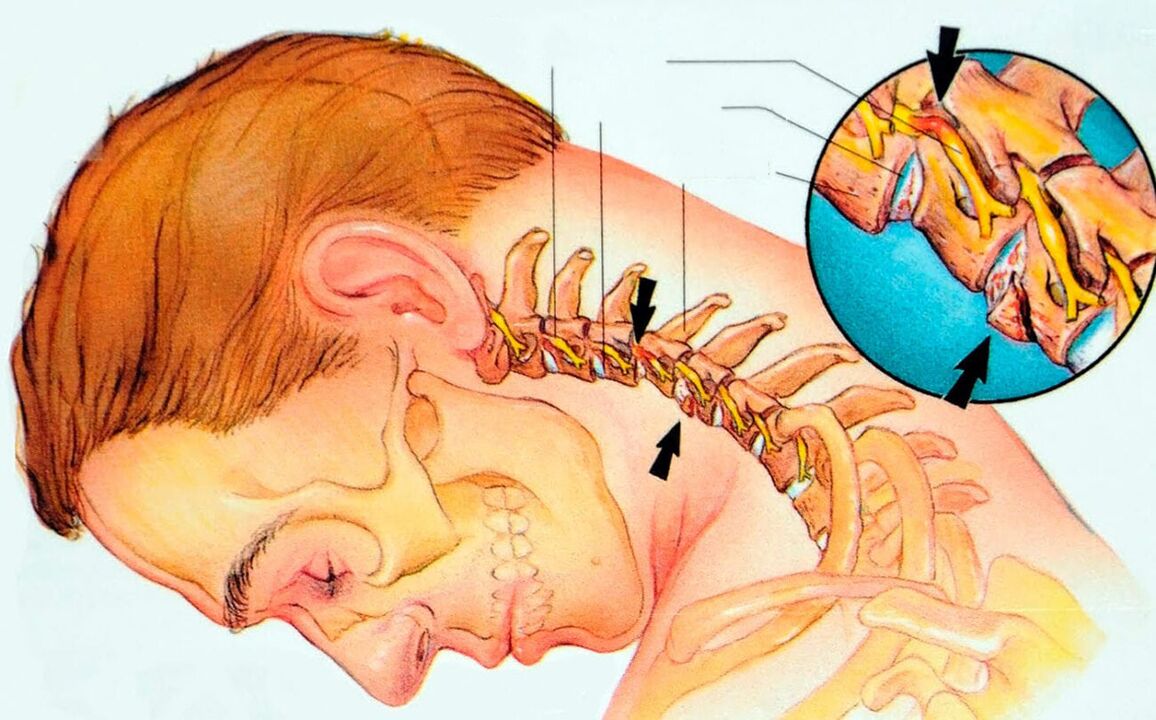 What is cervical osteochondosis