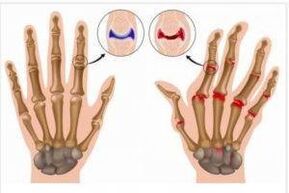 differences between arthritis and osteoarthritis of the hands