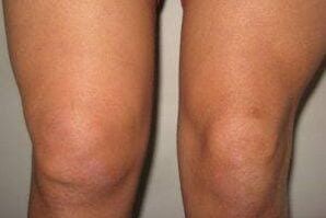 inflammation of the knee joint with arthritis and osteoarthritis