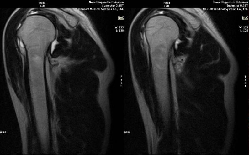 osteoarthritis of the shoulder joint on x-ray