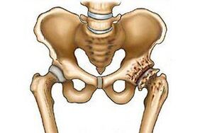 destruction of the hip joint in osteoarthritis