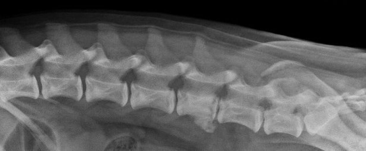 Manifestations of osteochondrosis of the thoracic spine on an x-ray
