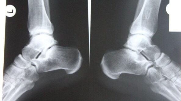 Diagnosis of ankle osteoarthritis by radiography