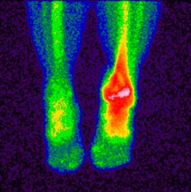 The differential diagnosis method for osteoarthritis is scintigraphy. 