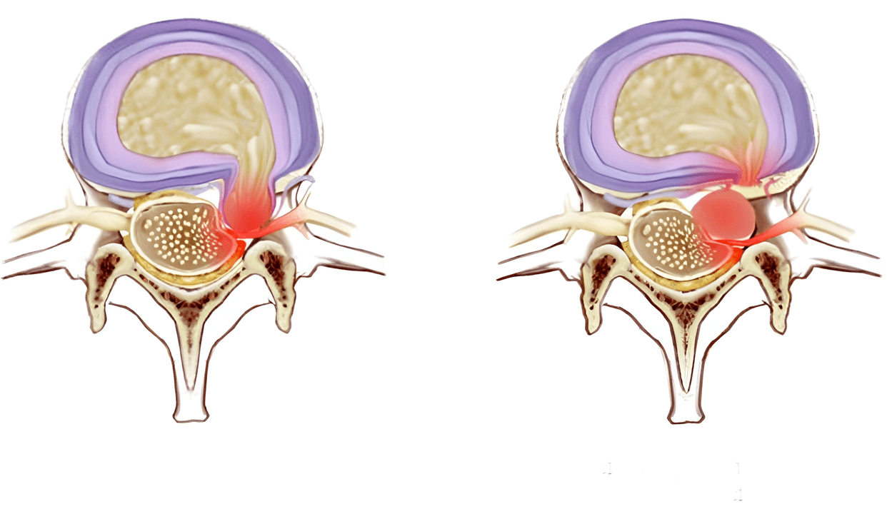 deformities of the intervertebral discs